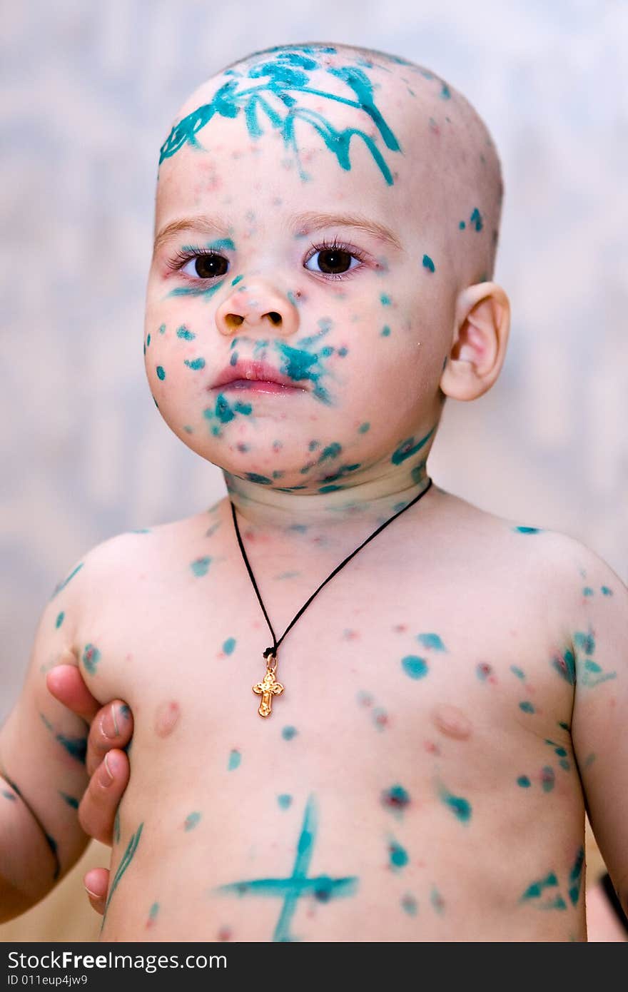 Chicken pox