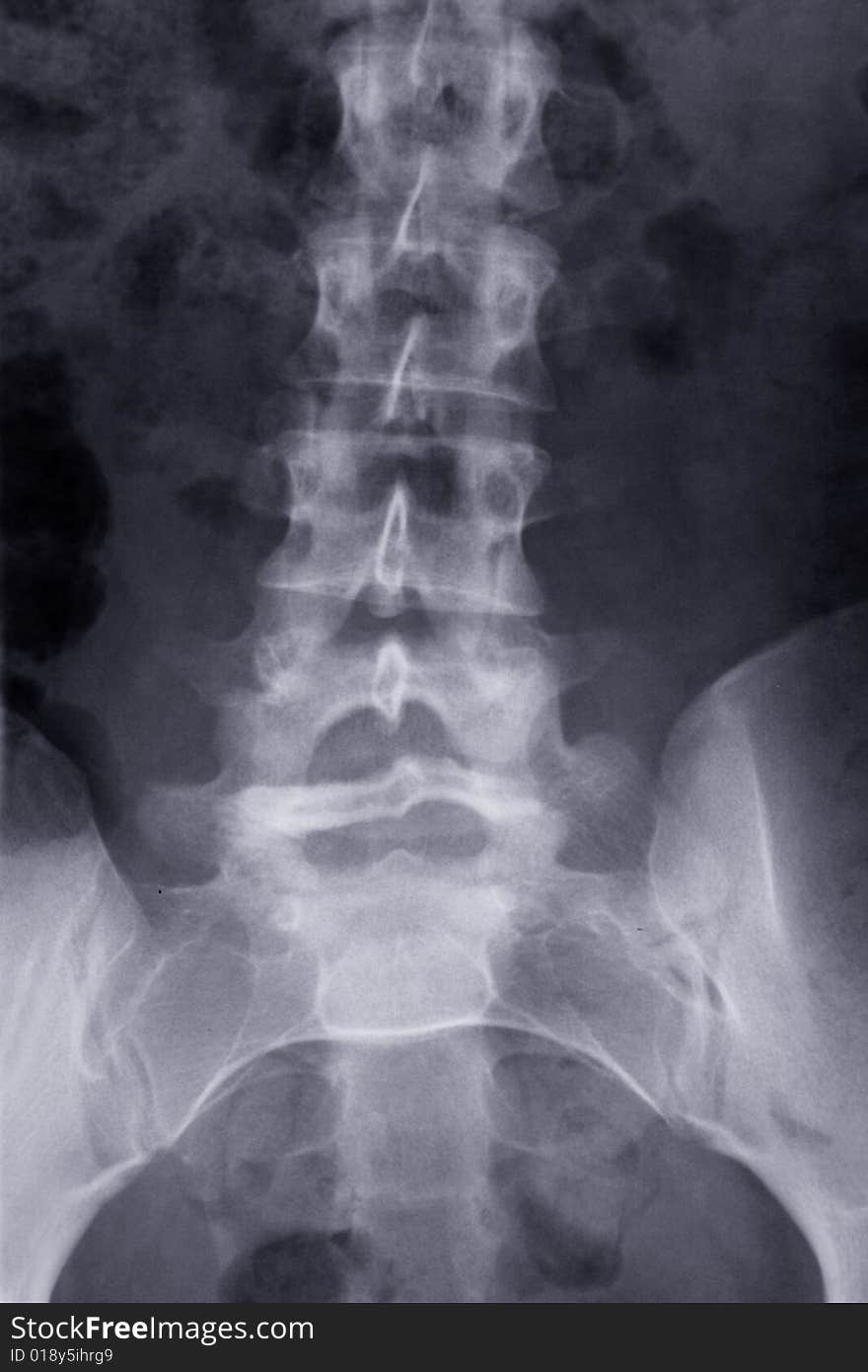 X-ray Picture