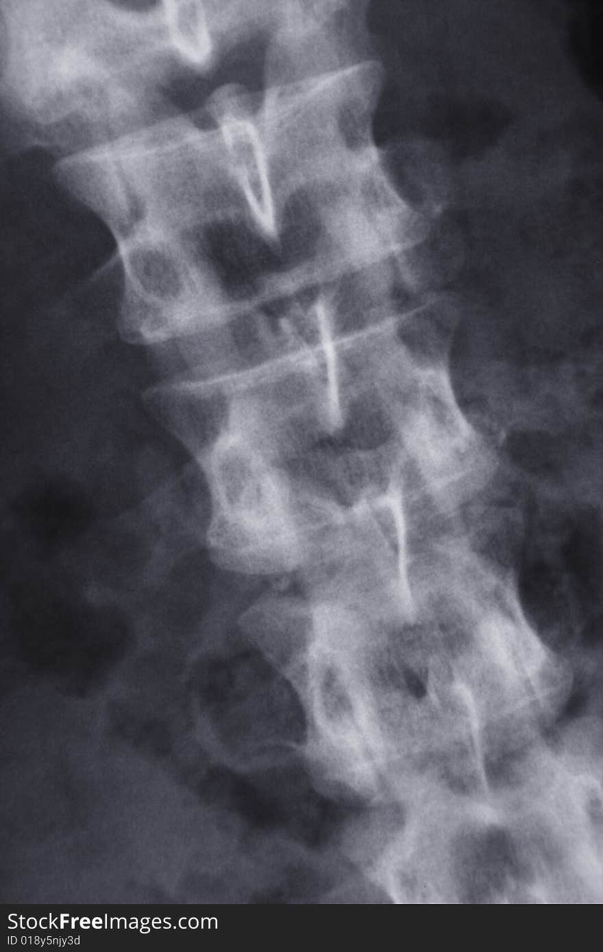 X-ray picture