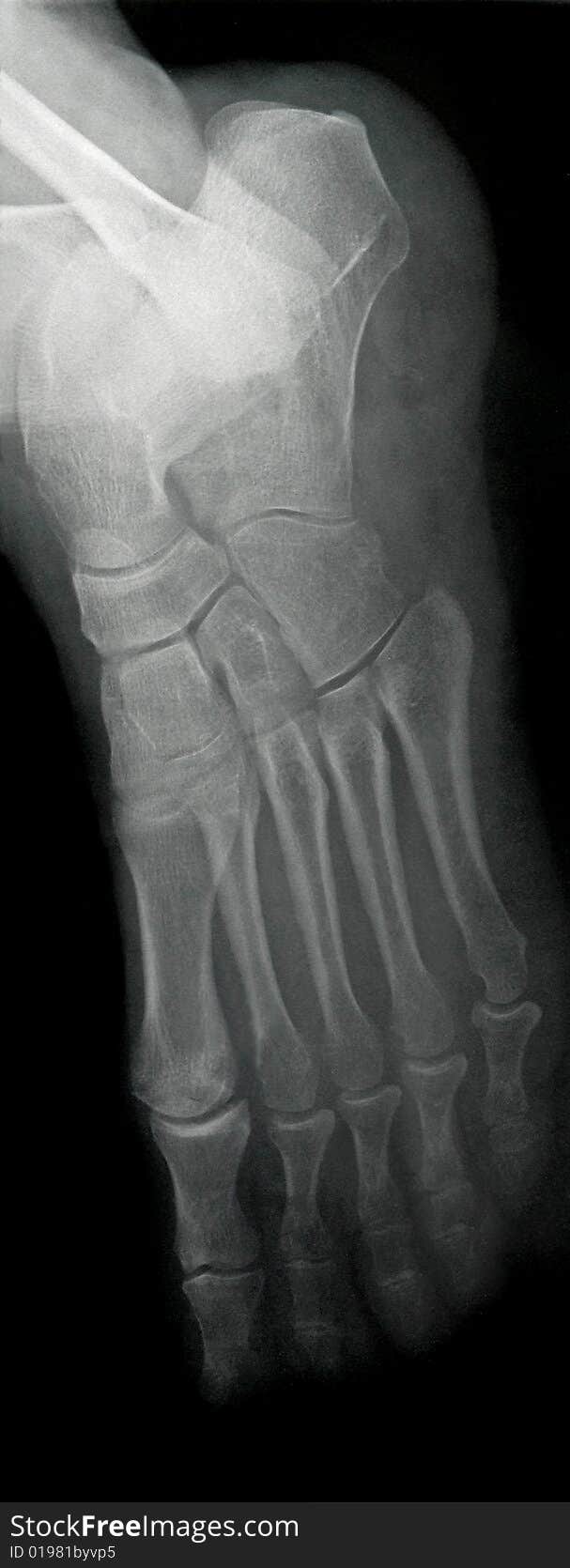 X-ray of human foot taken laterally from the side. Desaturated color image. X-ray of human foot taken laterally from the side. Desaturated color image.