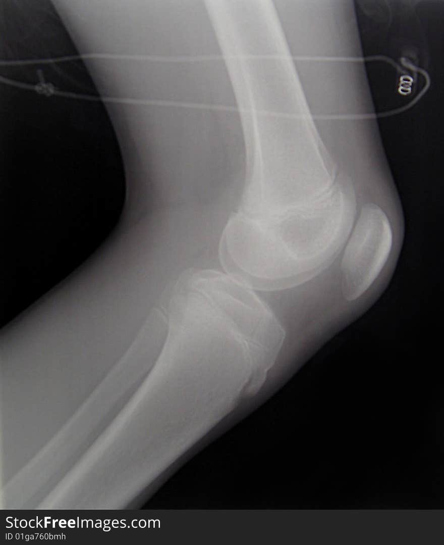 X-ray diagnostics/knee