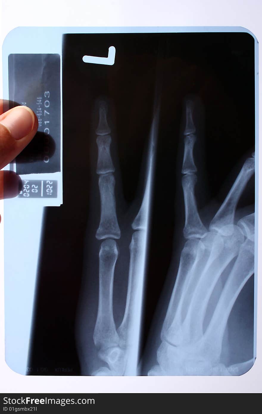 Xray of finger, medical background