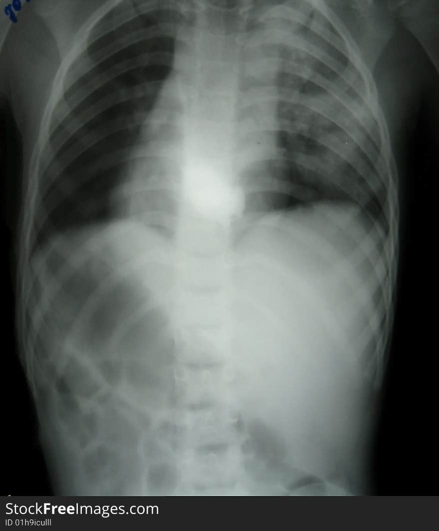 X-ray diagnostics of intestinal obstruction