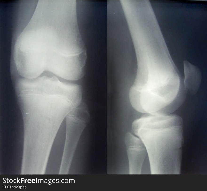 X-ray diagnostics/knee