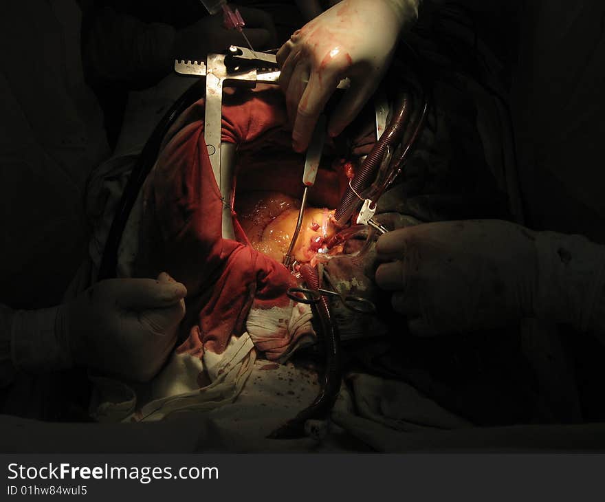 Coronary artery bypass surgery