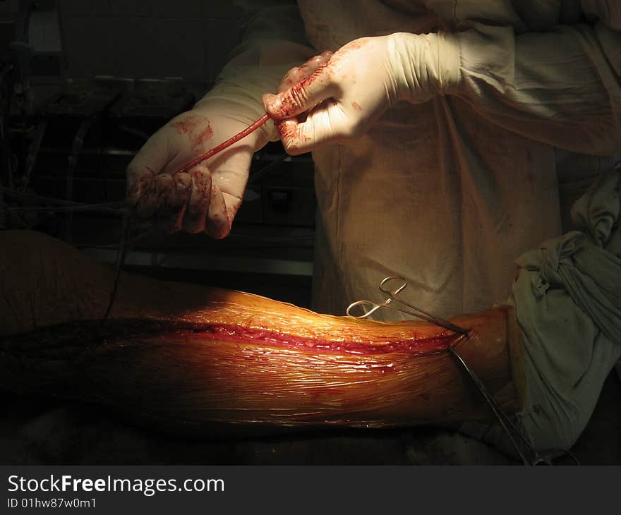 Coronary artery bypass surgery