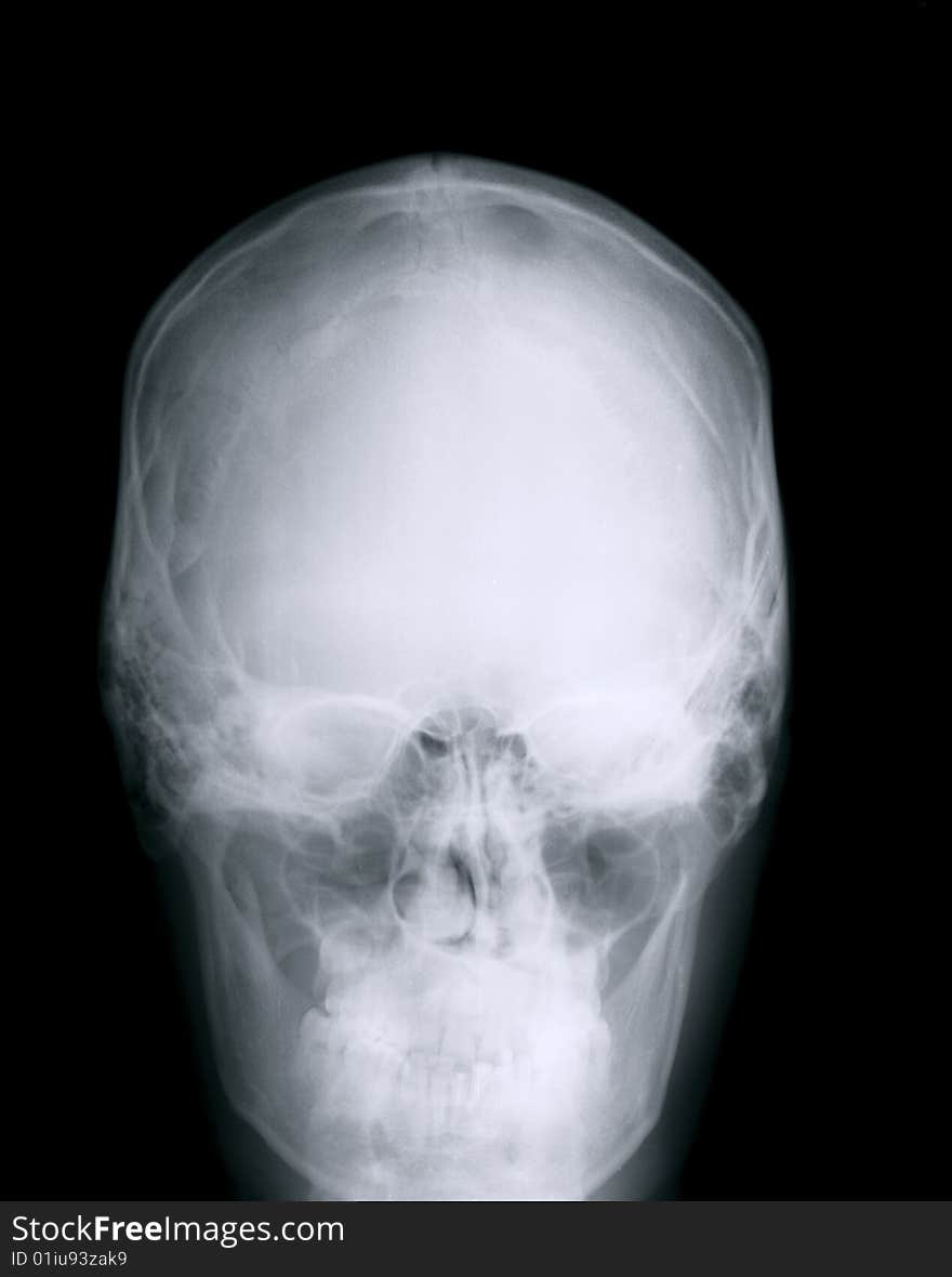 X-ray of a human skull, Negative film. X-ray of a human skull, Negative film