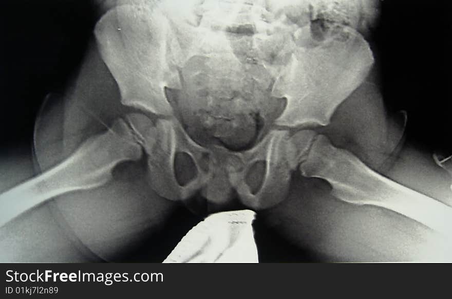 X-ray diagnostics of pelvic bones and hip joint. X-ray diagnostics of pelvic bones and hip joint