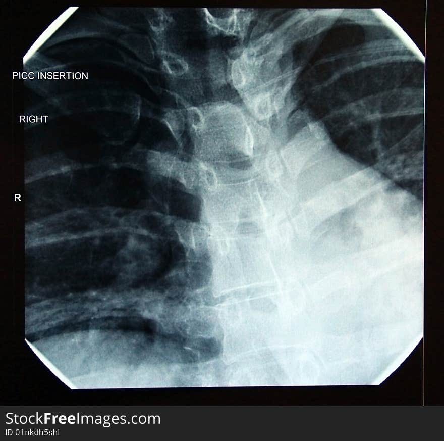 X-ray of correct final PICC line in heart