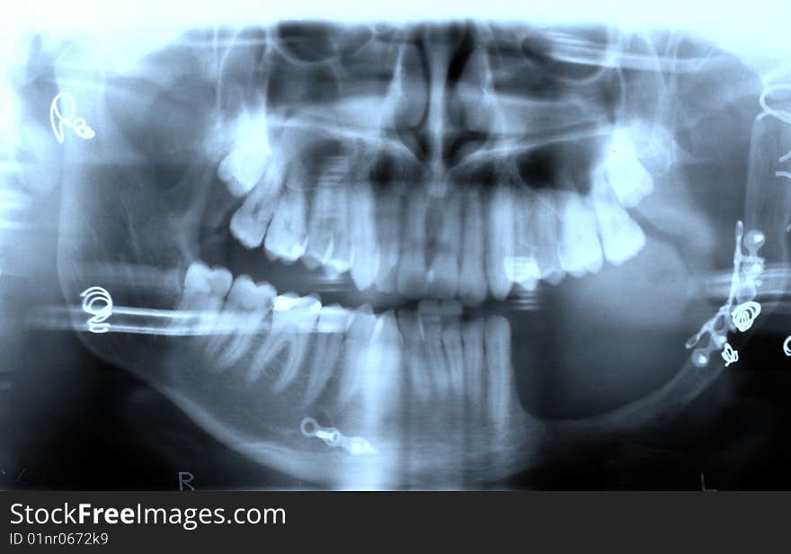 Medical Mouth x-ray shot