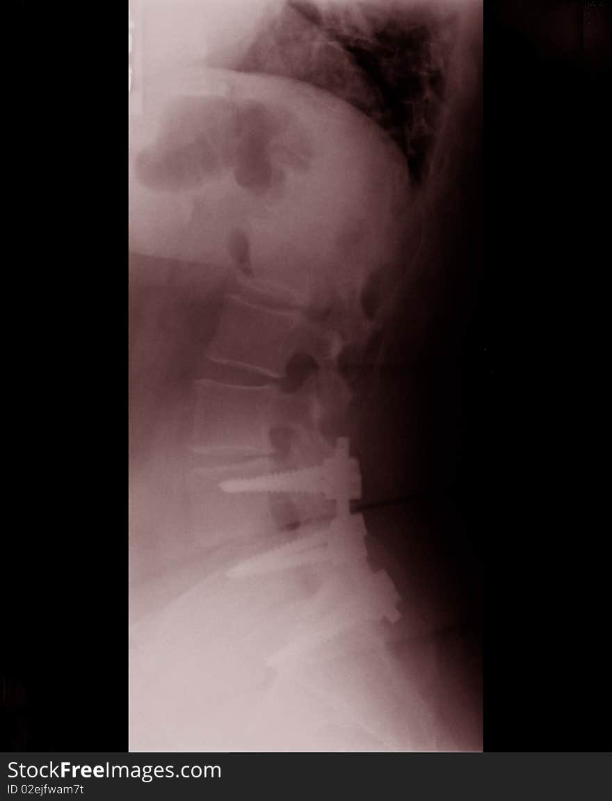 Spine X-ray