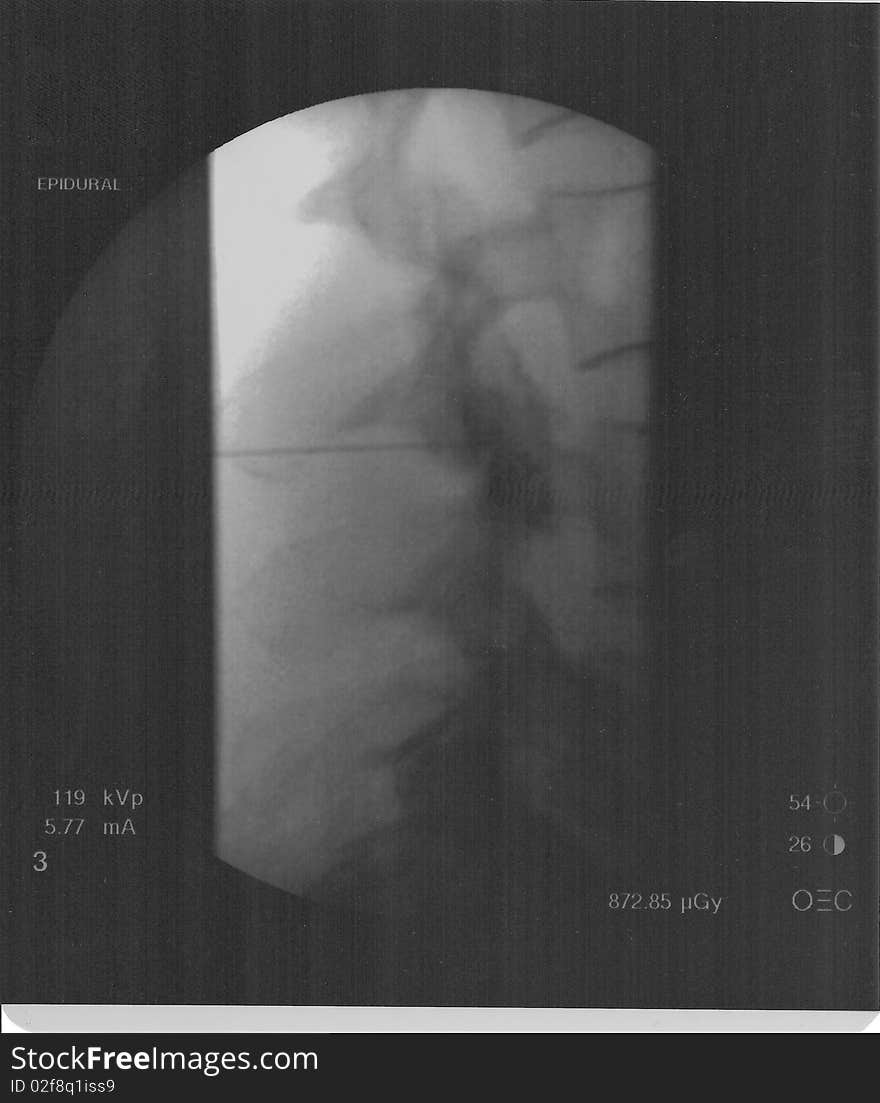 Lateral Epidural Injection