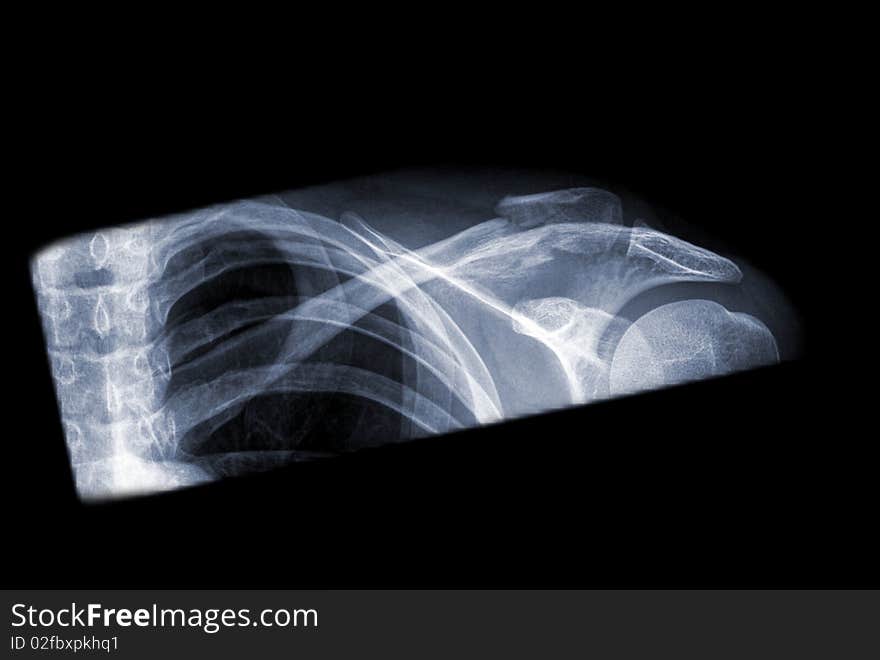 X-ray of a human clavicle ob black background