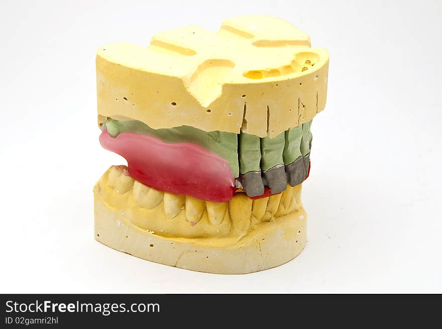 Dental bridge