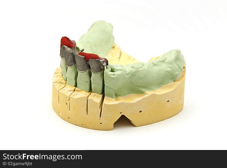 Dental bridge