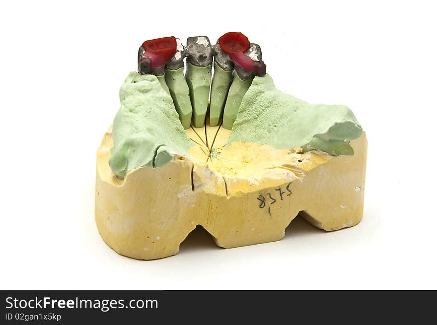 Dental Bridge