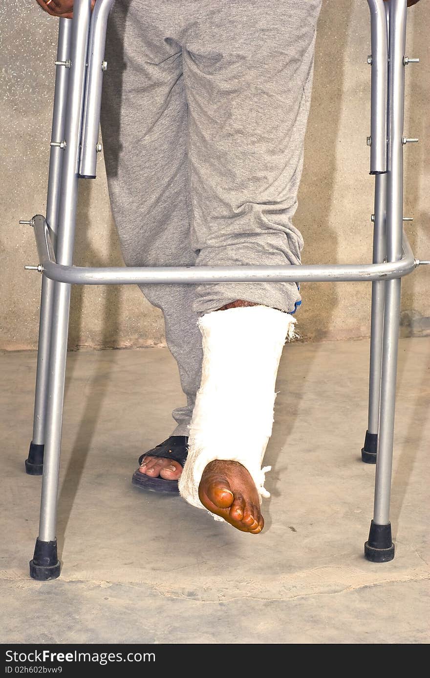 A patient is walking with plastered feet. He is walking with pipe stand/walker. A patient is walking with plastered feet. He is walking with pipe stand/walker.