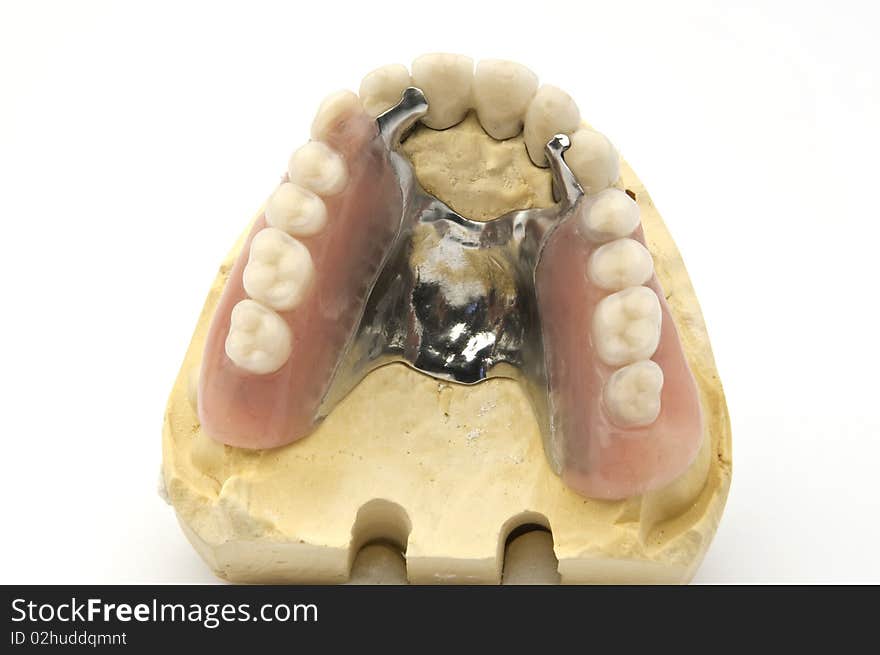 Fixed and mobil combined prosthesis on gypsum model. Fixed and mobil combined prosthesis on gypsum model