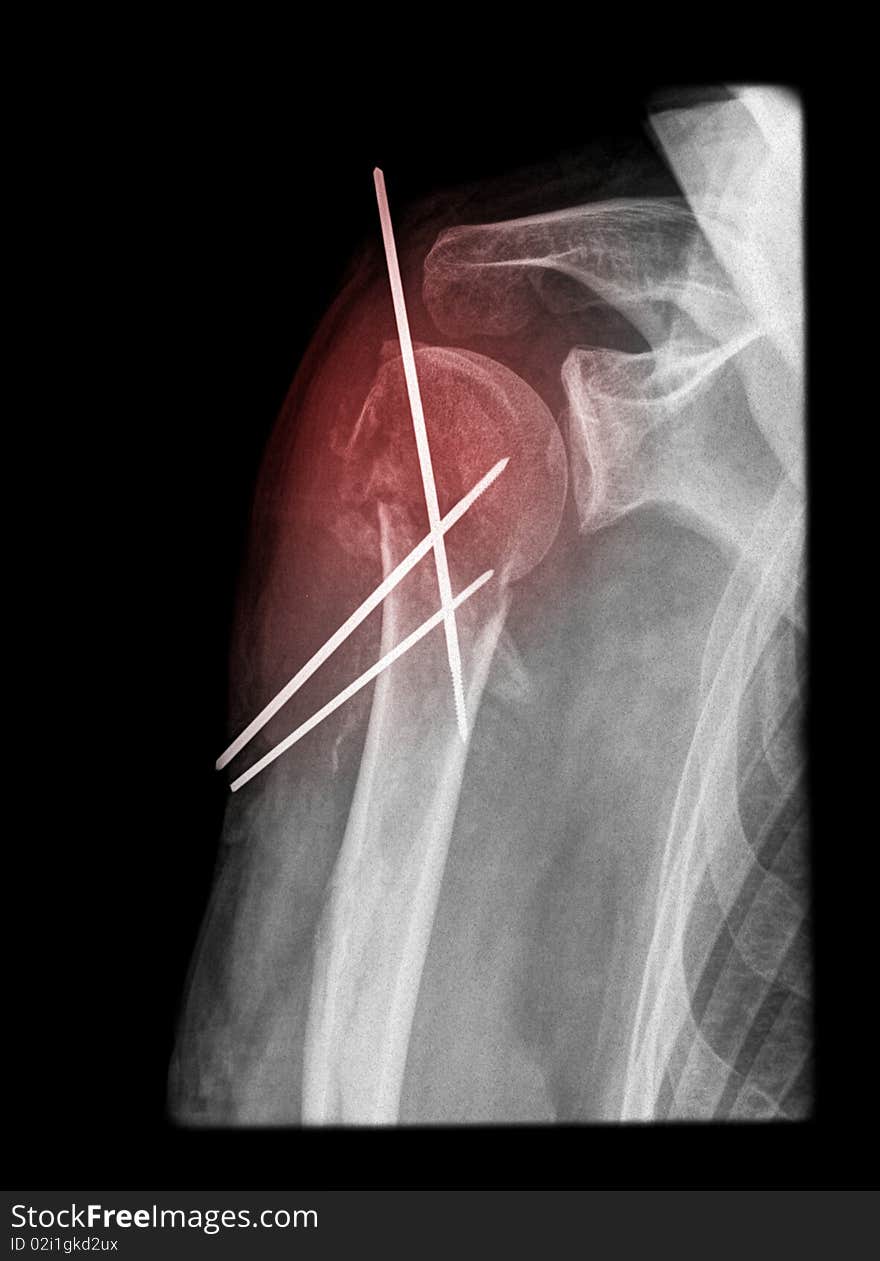 Painful shoulder surgery in an old woman isolated on black background on x-ray