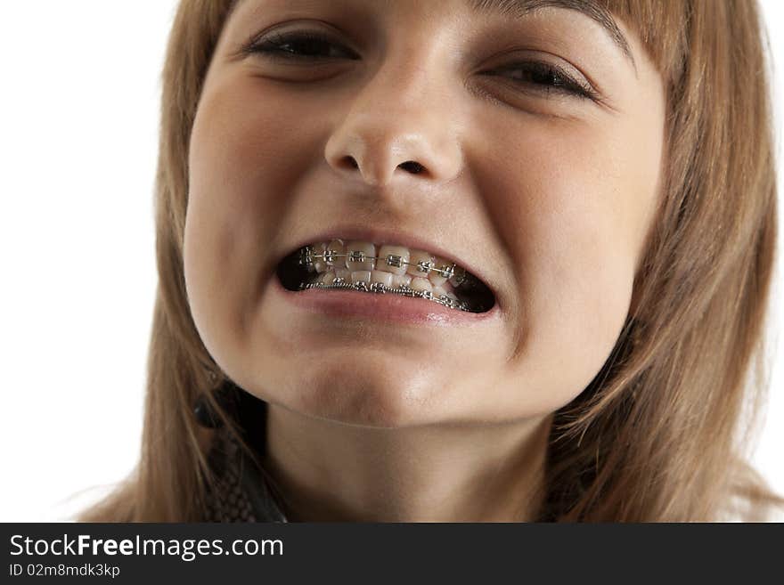 Young beautiful girl smiles with bracket on teeth