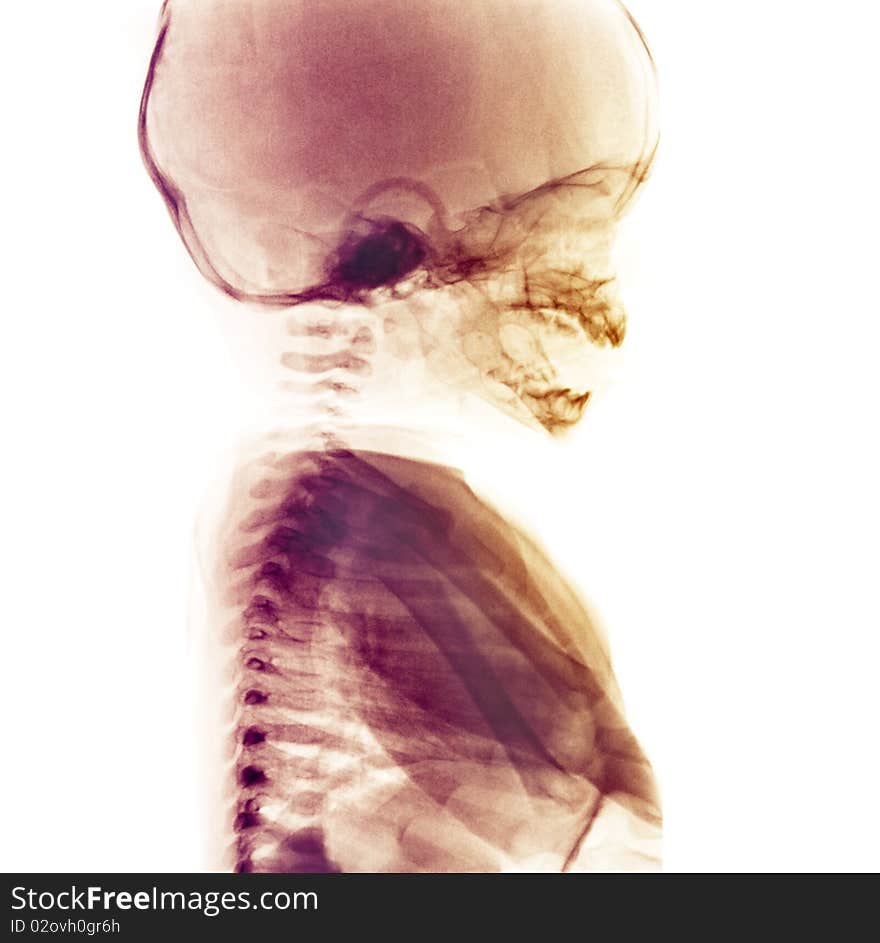 Normal head and thorax x-ray, 3 month old