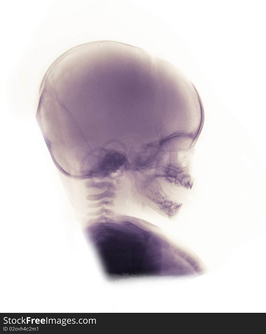 X-ray of a 3 month old female showing the normal anatomy of the skull and neck.