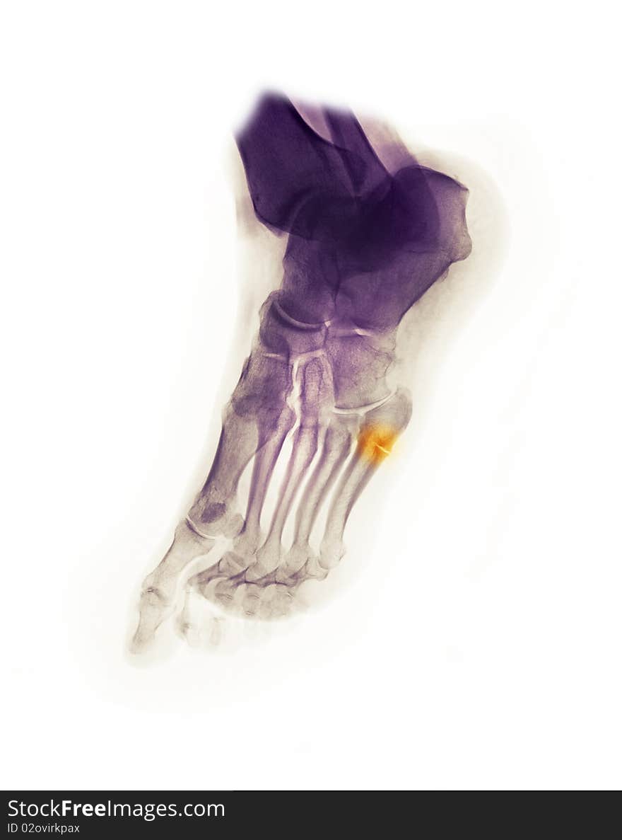 Foot x-ray of a 61 year old man showing a fracture of the 5th metatarsal. Foot x-ray of a 61 year old man showing a fracture of the 5th metatarsal