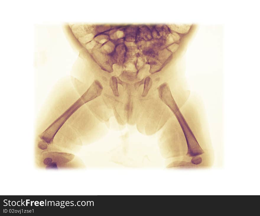 Pelvis x-ray of a 3 month old girl showing normal anatomy of the developing bones. Pelvis x-ray of a 3 month old girl showing normal anatomy of the developing bones