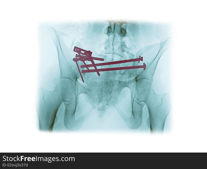 X-ray of the pelvis of a 21 year old woman who required surgical repair of a pelvis fracture from a car accident. This patient was not wearing a seat belt. X-ray of the pelvis of a 21 year old woman who required surgical repair of a pelvis fracture from a car accident. This patient was not wearing a seat belt.