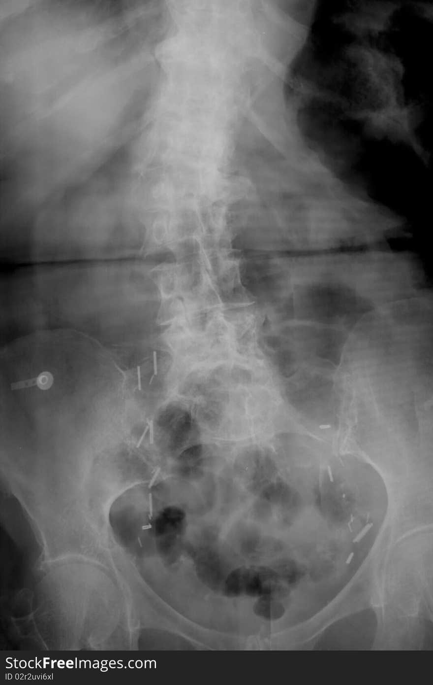 Lumbar spine with scoliosis, pins, clips, and from previous surgery. Lumbar spine with scoliosis, pins, clips, and from previous surgery