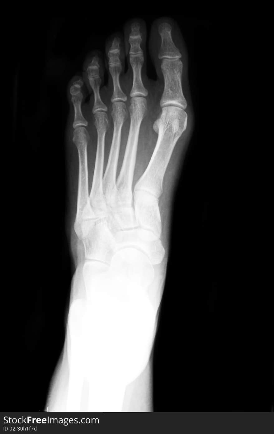 Anterior posterior xray of foot. Anterior posterior xray of foot