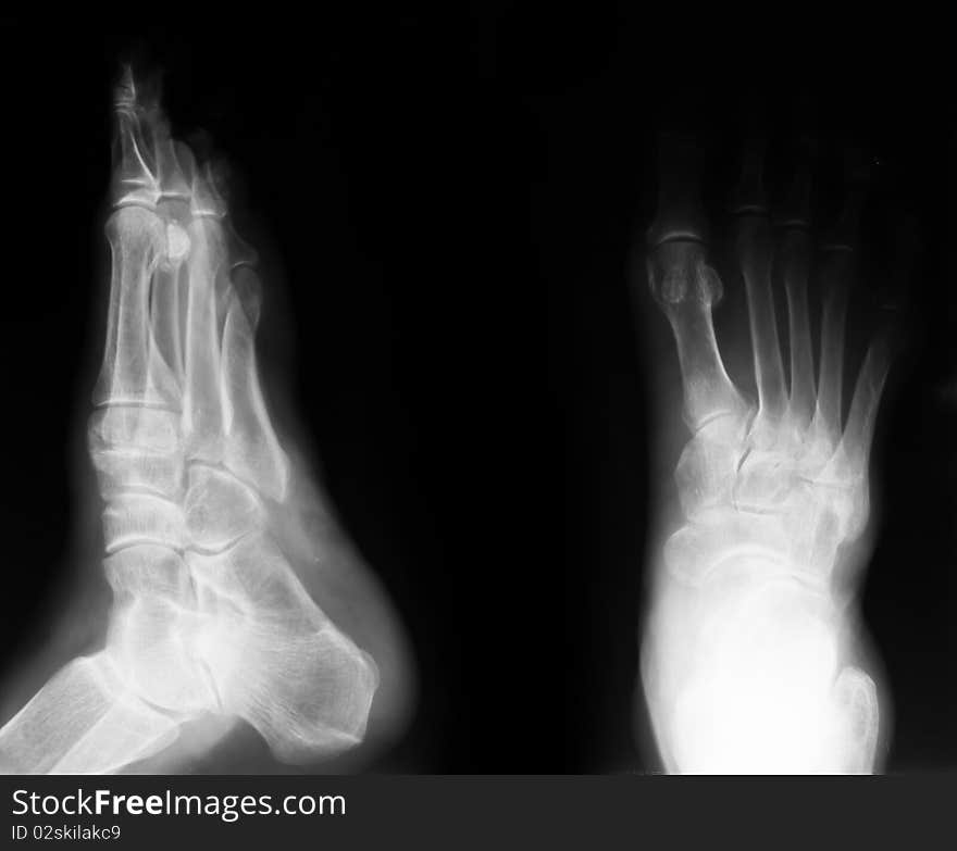 Detail of x-ray image : human feet. Detail of x-ray image : human feet