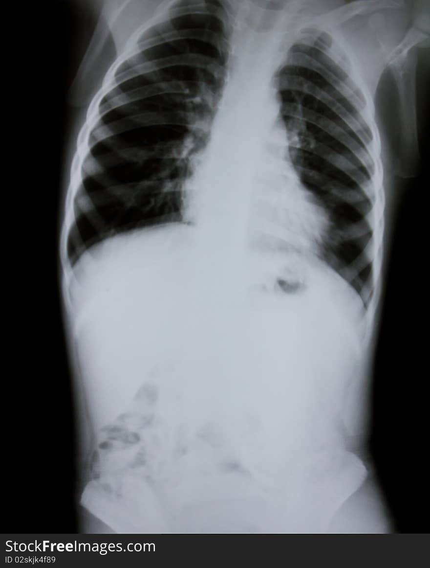 Detail of x-ray image : Chest x-ray of young boy