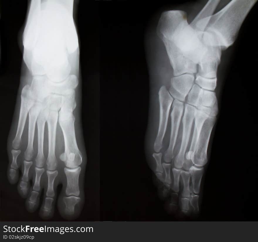 X-ray of both human feet. 
No fracture.