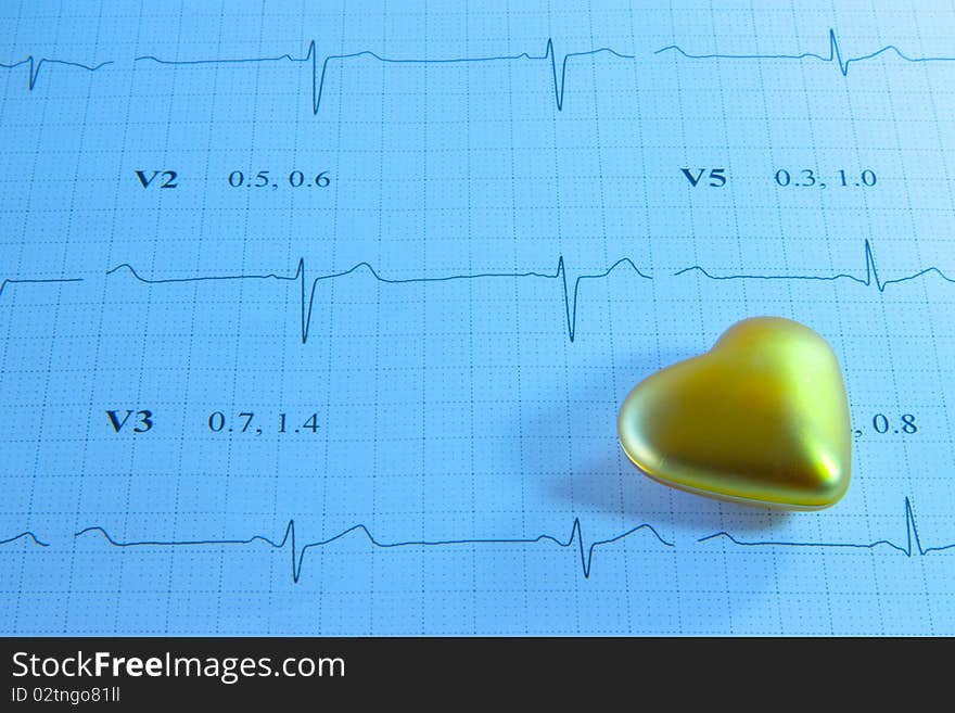 EKG Printout