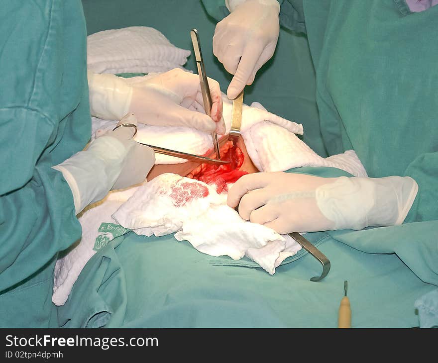 Cesarean operation