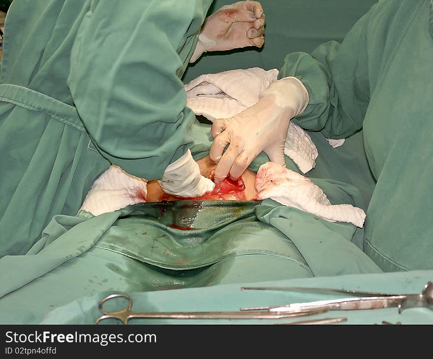 Caesarean Operation