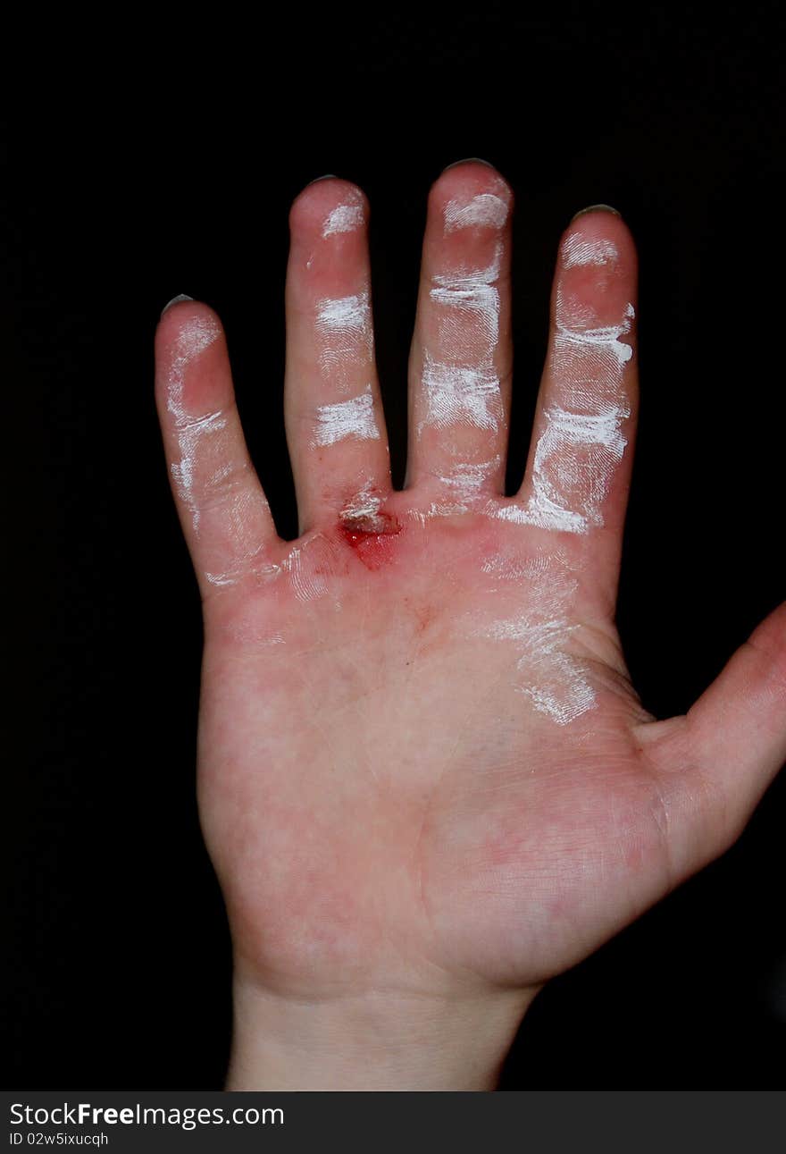 Chalked weightlifter's hand with a torn callous. Chalked weightlifter's hand with a torn callous