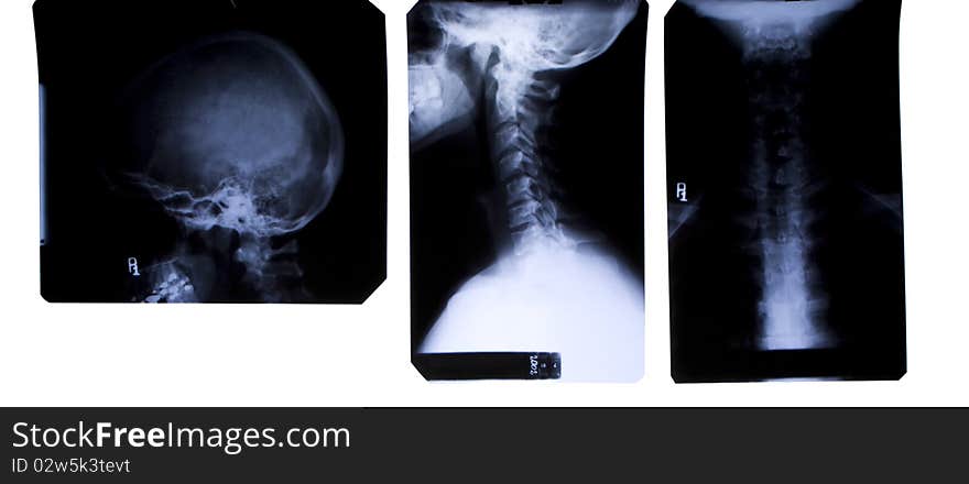 X-Ray film of neck and head - three views - front and side. X-Ray film of neck and head - three views - front and side