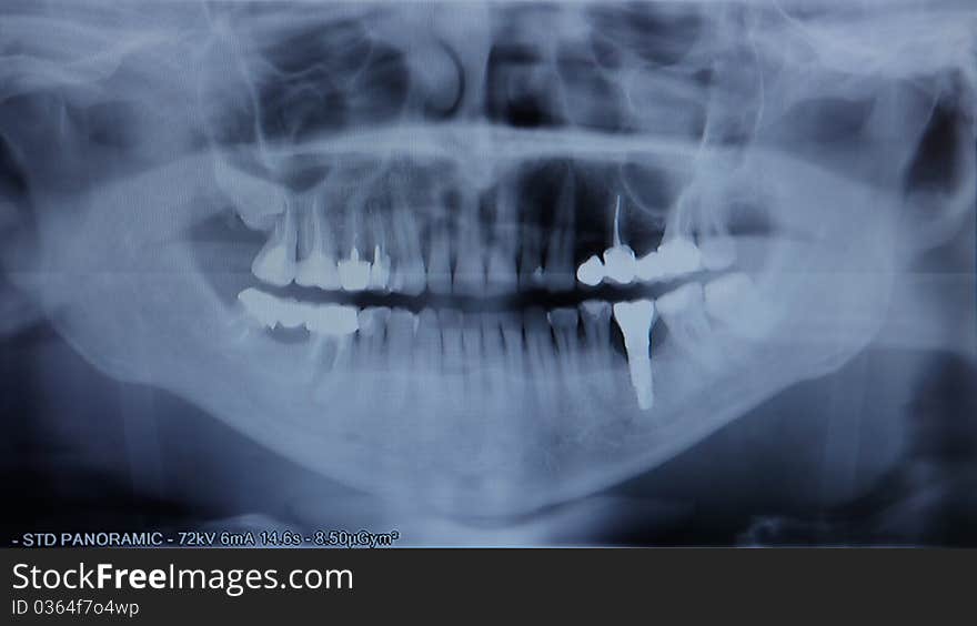 X-ray of the jaw close up. X-ray of the jaw close up