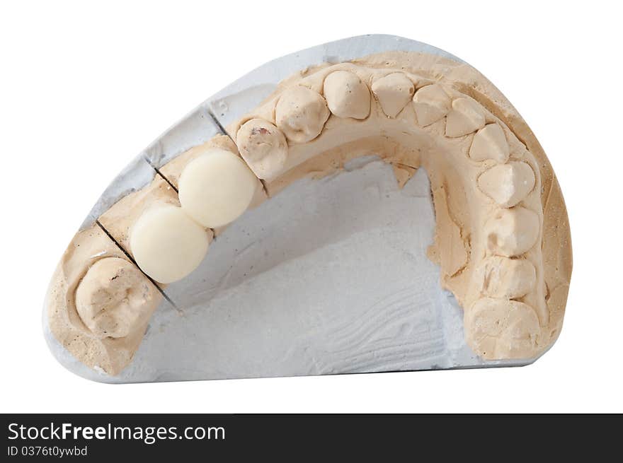 Dental Prosthesis