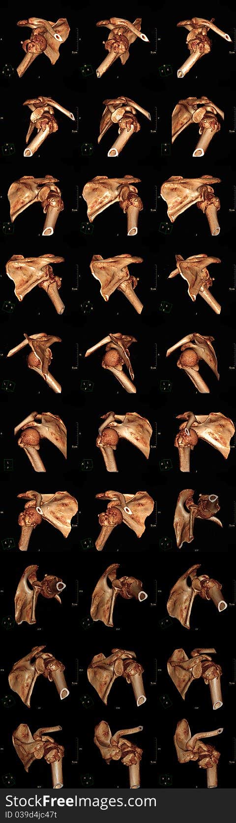 Three-dimensional reconstruction of a computed tomogramm of the shoulder joint showing a fracture of humeral bone. Three-dimensional reconstruction of a computed tomogramm of the shoulder joint showing a fracture of humeral bone