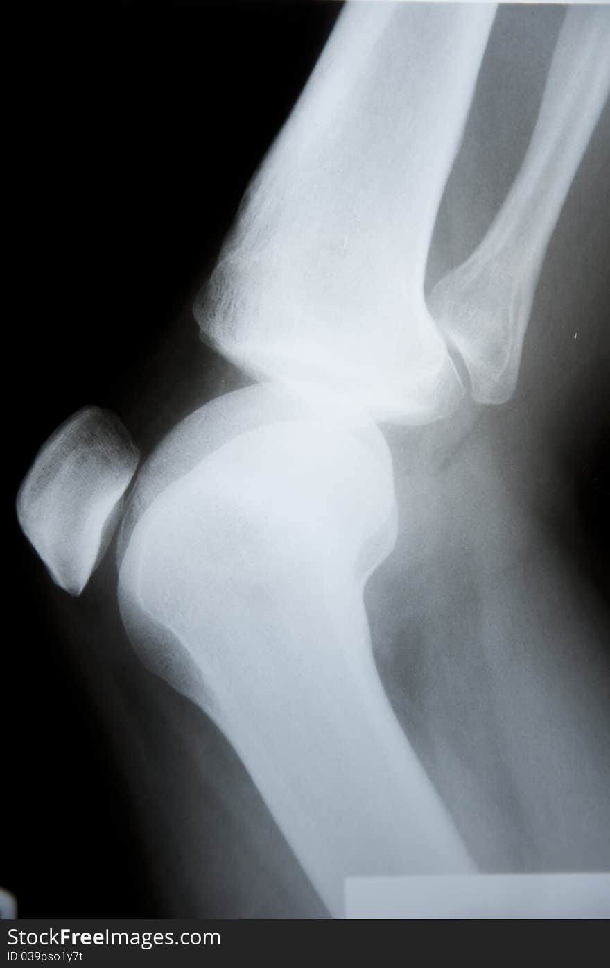 X-ray pathology human knee