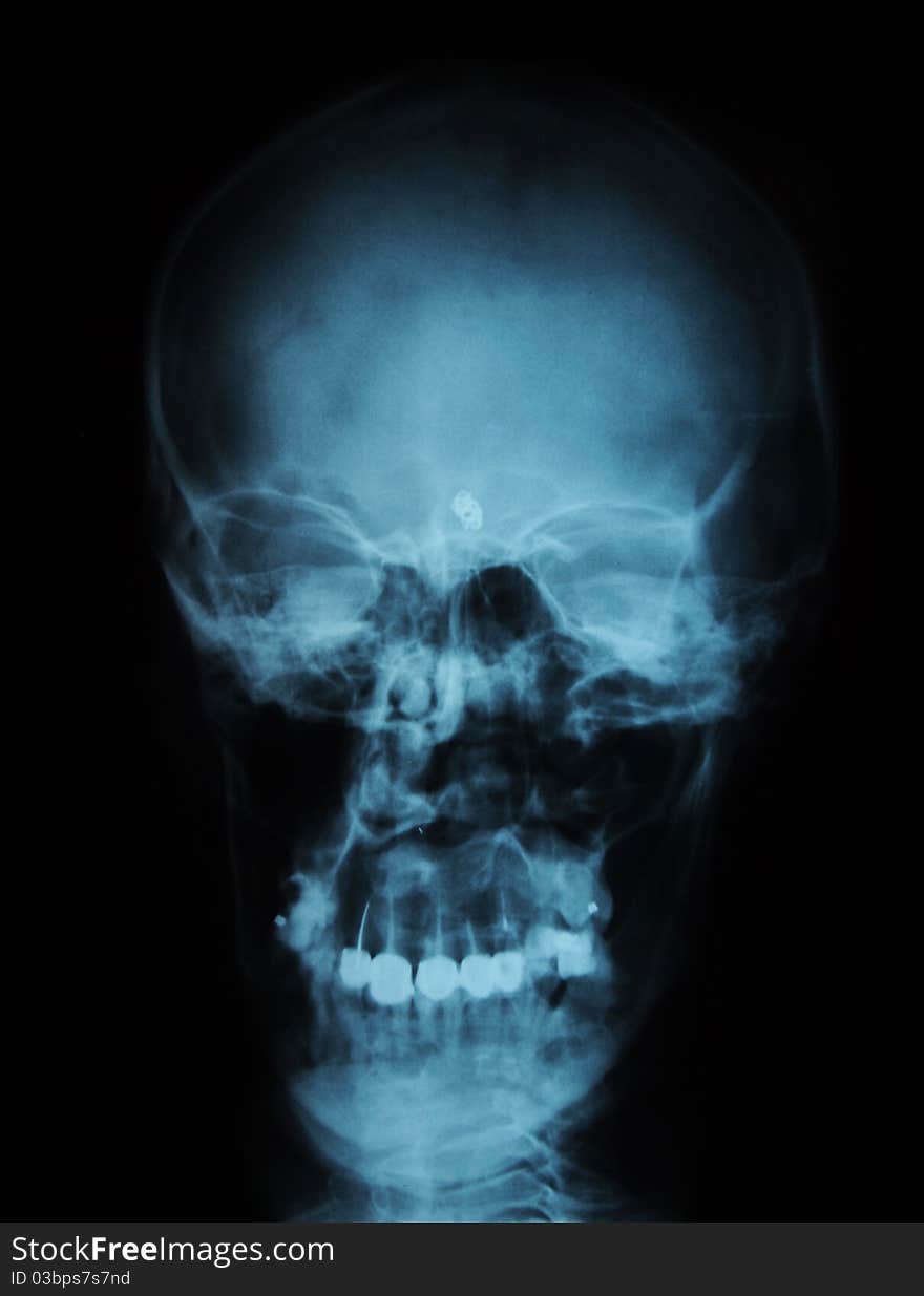 X-ray/ rtg of human head (black background). X-ray/ rtg of human head (black background)