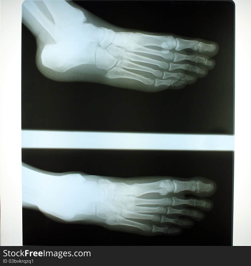 An x-ray of a human foot. An x-ray of a human foot