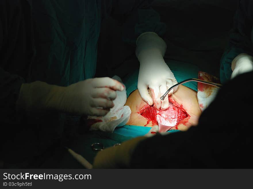 New born infant in the operation room