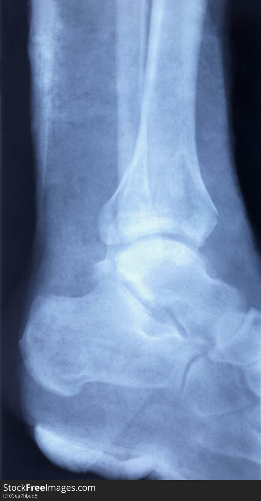 X-ray Image Of Human Foot