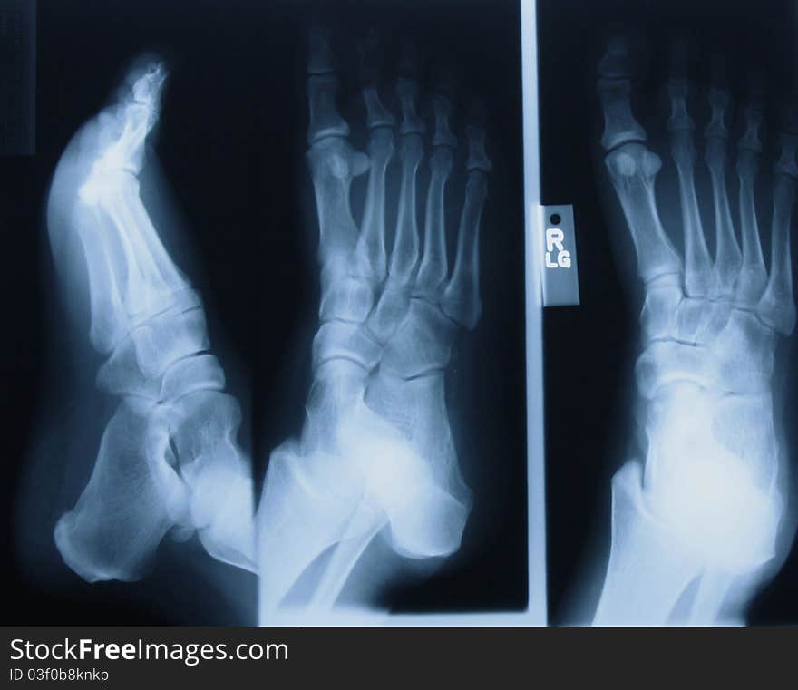 Digital image of an x-ray of a rt foot showing three views. Digital image of an x-ray of a rt foot showing three views.