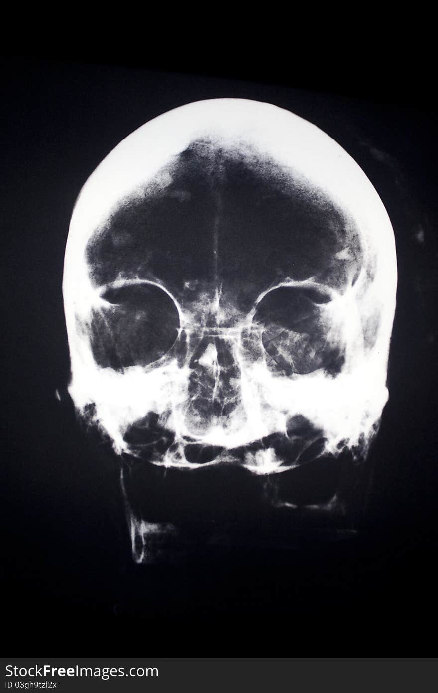 X-Ray of a human head