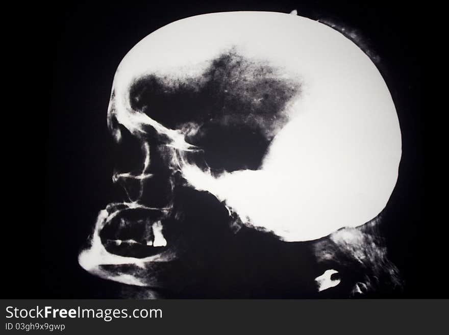 X-Ray of a human head showing the side view.